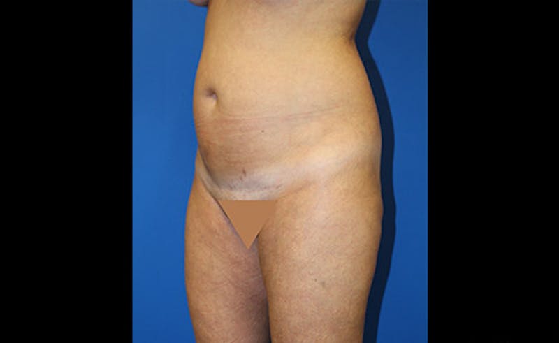 Liposuction Before & After Gallery - Patient 229267 - Image 3