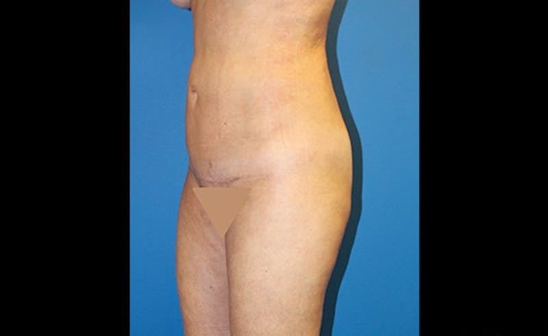 Liposuction Before & After Gallery - Patient 229267 - Image 4