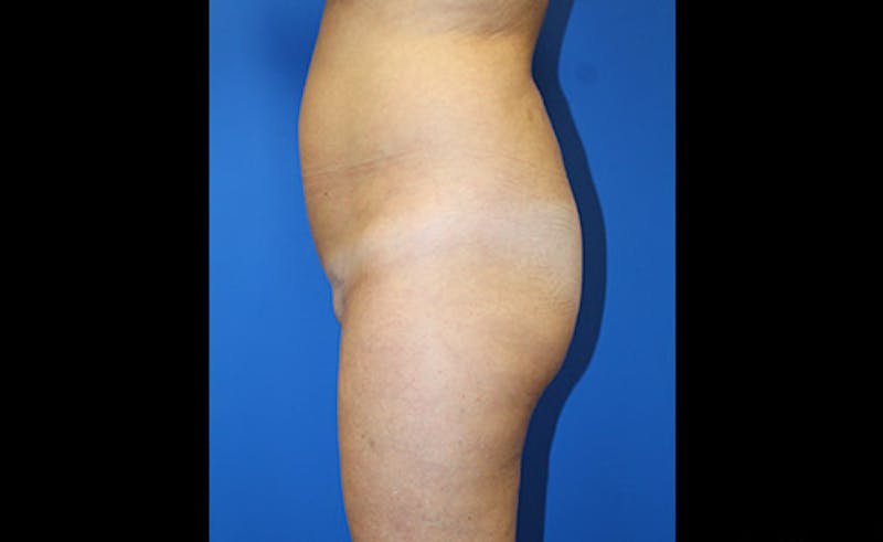 Liposuction Before & After Gallery - Patient 229267 - Image 5