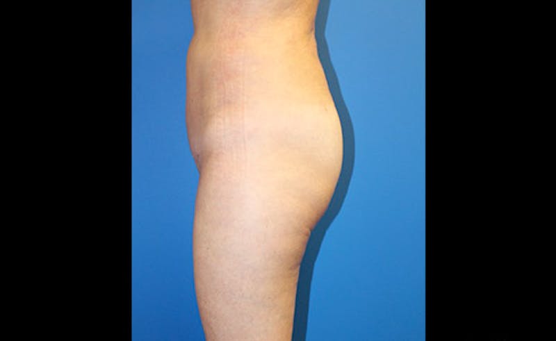 Liposuction Before & After Gallery - Patient 229267 - Image 6