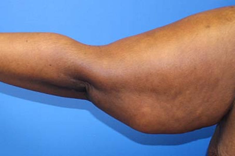 Brachioplasty Before & After Gallery - Patient 196134 - Image 1
