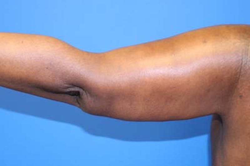 Brachioplasty Before & After Gallery - Patient 196134 - Image 2