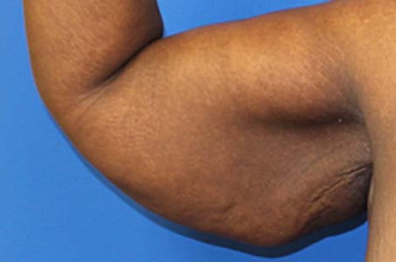 Brachioplasty Before & After Gallery - Patient 196134 - Image 3
