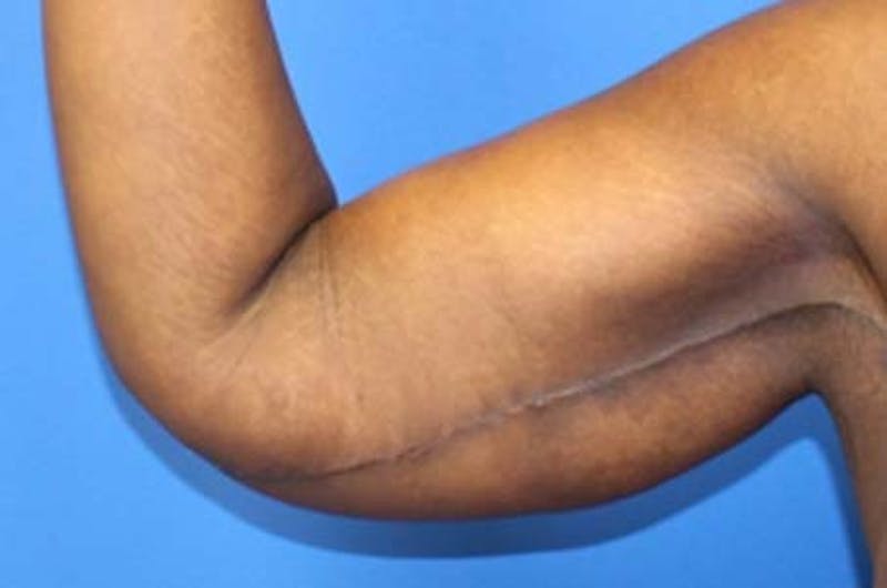 Brachioplasty Before & After Gallery - Patient 196134 - Image 4