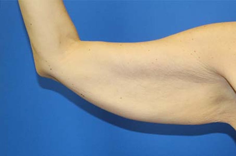 Brachioplasty Before & After Gallery - Patient 272003 - Image 1