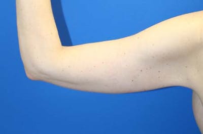 Brachioplasty Before & After Gallery - Patient 272003 - Image 2
