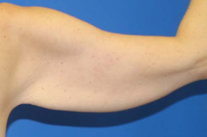 Brachioplasty Before & After Gallery - Patient 272003 - Image 3