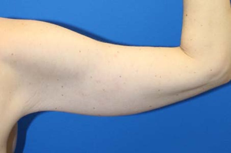 Brachioplasty Before & After Gallery - Patient 272003 - Image 4