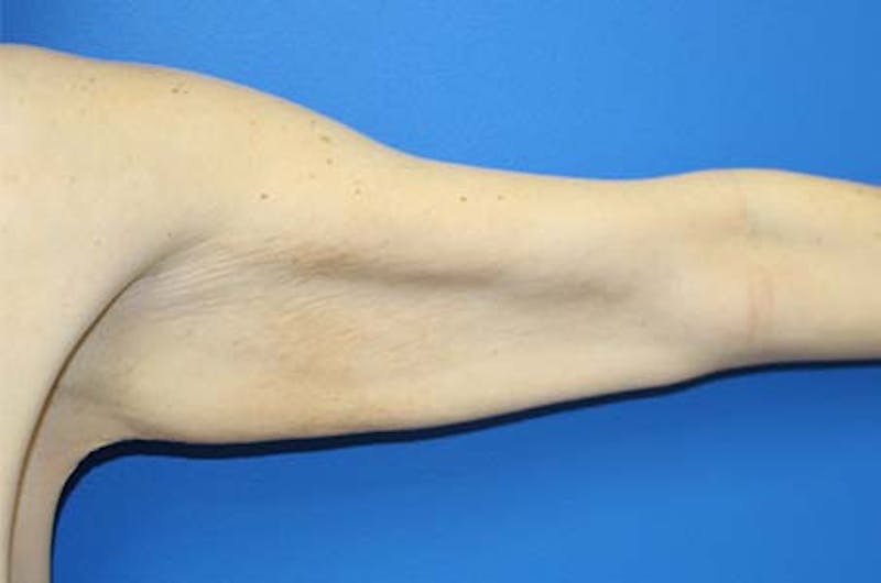 Brachioplasty Before & After Gallery - Patient 272003 - Image 5