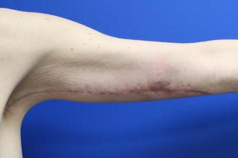 Brachioplasty Before & After Gallery - Patient 272003 - Image 6