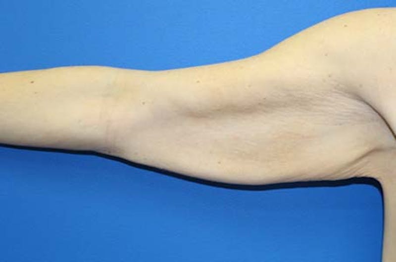 Brachioplasty Before & After Gallery - Patient 272003 - Image 7