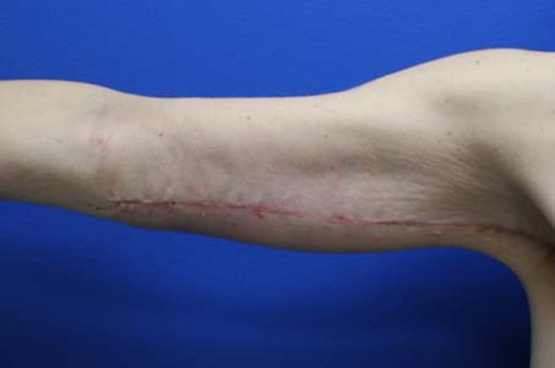 Brachioplasty Before & After Gallery - Patient 272003 - Image 8