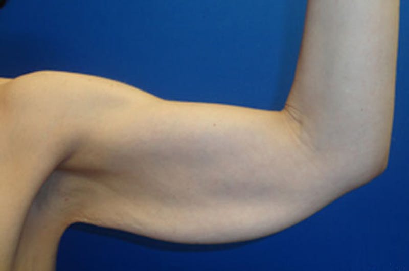 Brachioplasty Before & After Gallery - Patient 293932 - Image 1