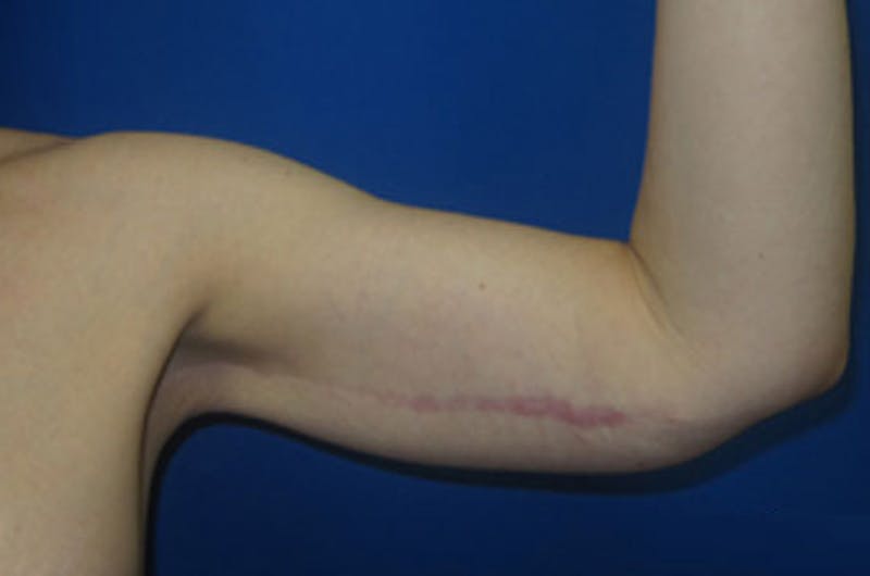 Brachioplasty Before & After Gallery - Patient 293932 - Image 2