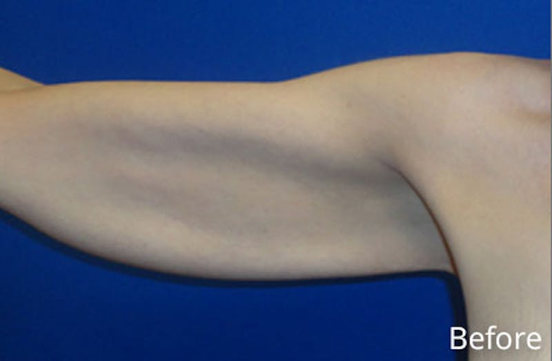 Brachioplasty Before & After Gallery - Patient 293932 - Image 3