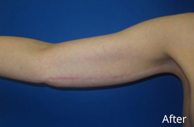 Brachioplasty Before & After Gallery - Patient 293932 - Image 4