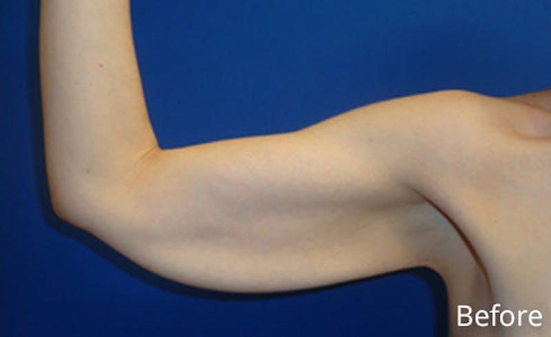Brachioplasty Before & After Gallery - Patient 293932 - Image 5