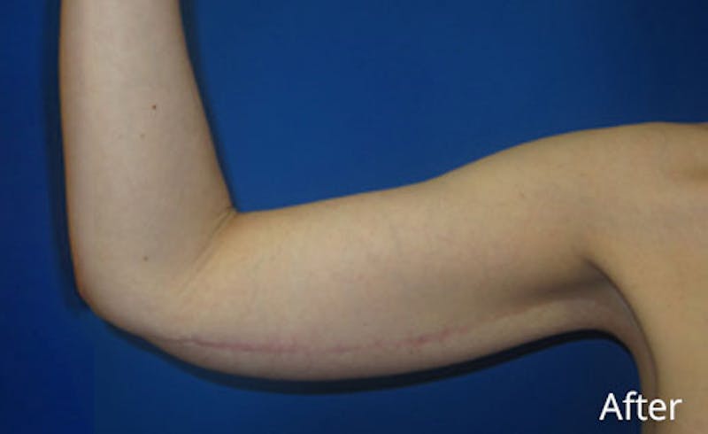 Brachioplasty Before & After Gallery - Patient 293932 - Image 6