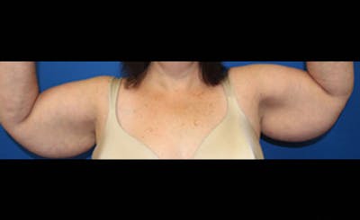 Brachioplasty Before & After Gallery - Patient 243185 - Image 1