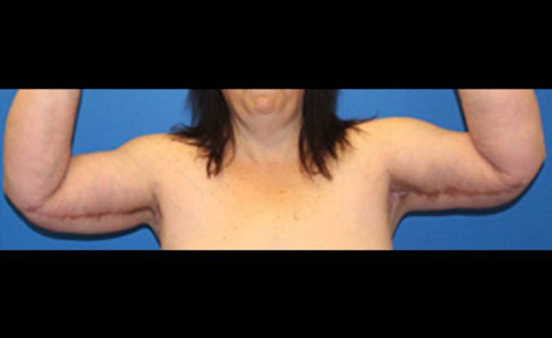 Brachioplasty Before & After Gallery - Patient 243185 - Image 2