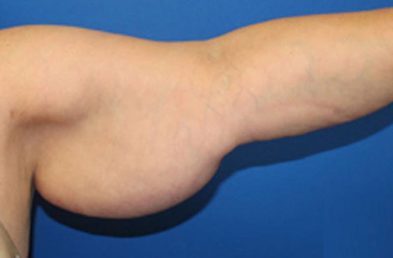 Brachioplasty Before & After Gallery - Patient 243185 - Image 3