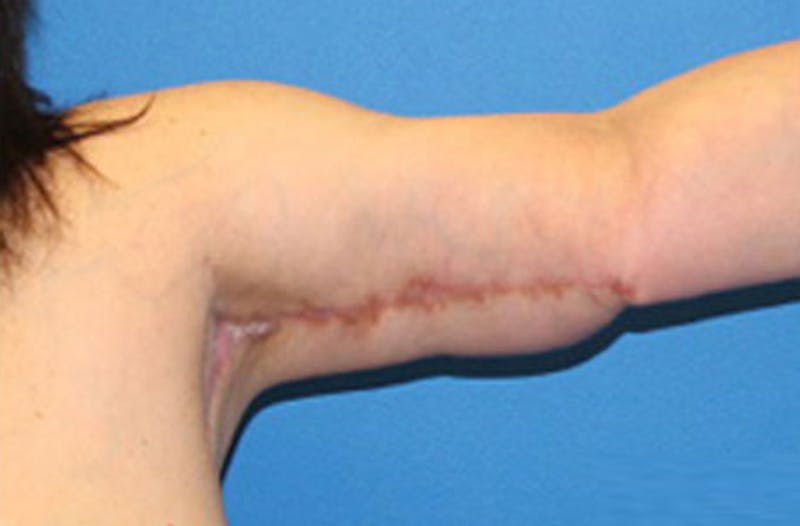 Brachioplasty Before & After Gallery - Patient 243185 - Image 4