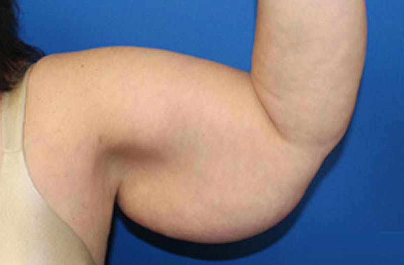 Brachioplasty Before & After Gallery - Patient 243185 - Image 5