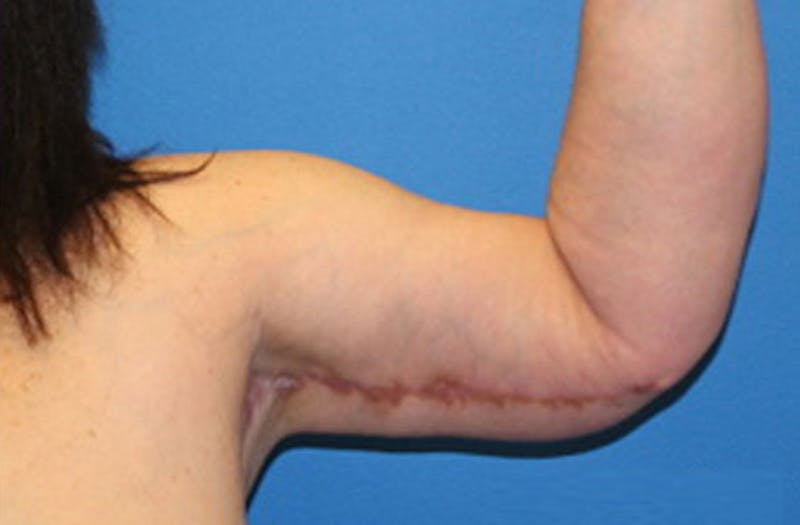 Brachioplasty Before & After Gallery - Patient 243185 - Image 6