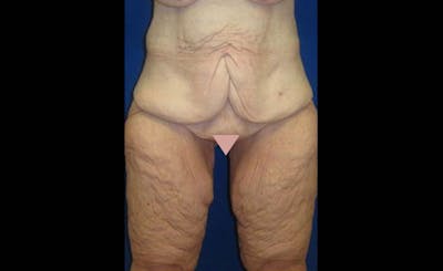 Body Lift Before & After Gallery - Patient 221571 - Image 1