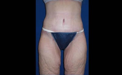 Body Lift Before & After Gallery - Patient 221571 - Image 2