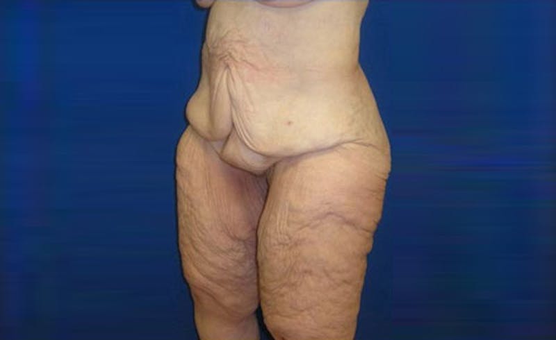 Body Lift Before & After Gallery - Patient 221571 - Image 3