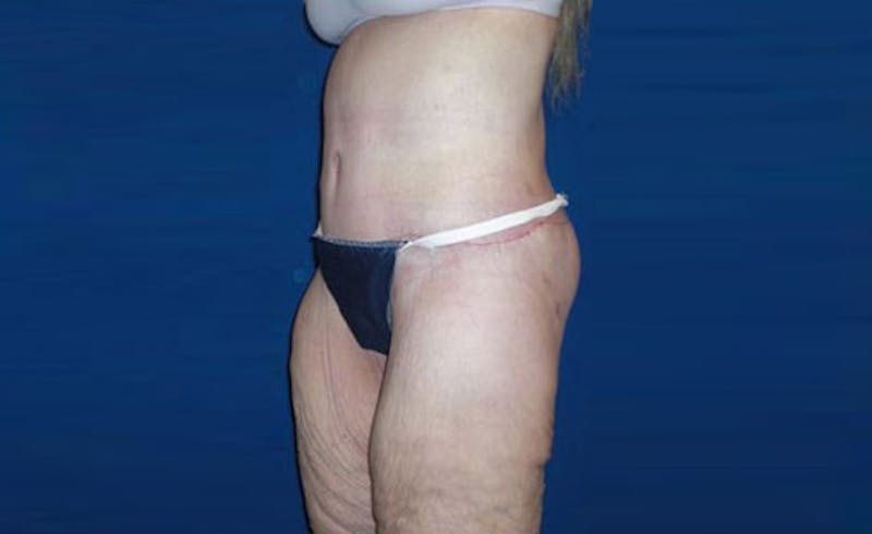Body Lift Before & After Gallery - Patient 221571 - Image 4
