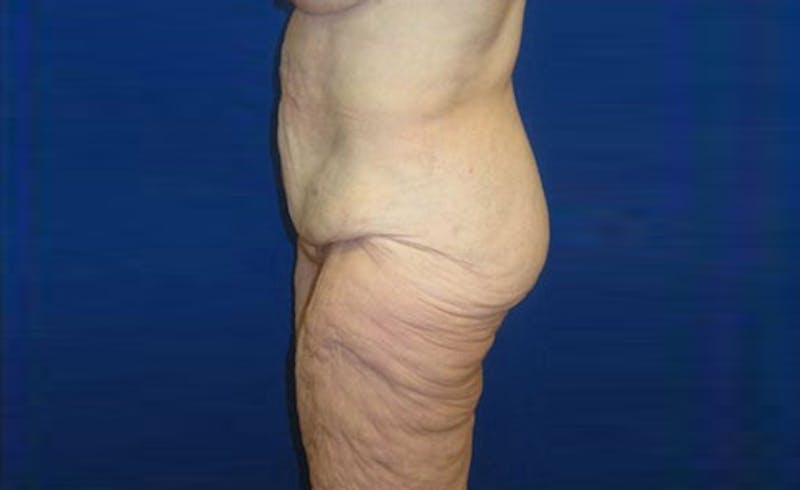 Body Lift Before & After Gallery - Patient 221571 - Image 5