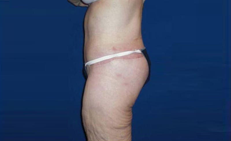 Body Lift Before & After Gallery - Patient 221571 - Image 6