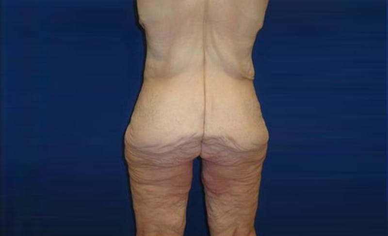 Body Lift Before & After Gallery - Patient 221571 - Image 7