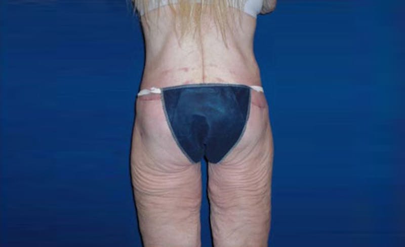 Body Lift Before & After Gallery - Patient 221571 - Image 8