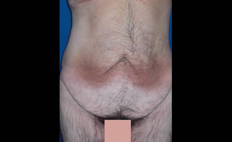 Body Lift Before & After Gallery - Patient 398385 - Image 1