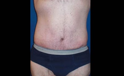 Body Lift Before & After Gallery - Patient 398385 - Image 2