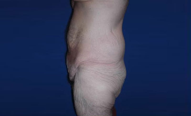 Body Lift Before & After Gallery - Patient 398385 - Image 3