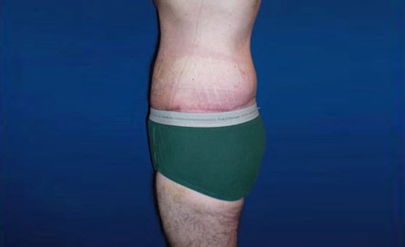 Body Lift Before & After Gallery - Patient 398385 - Image 4