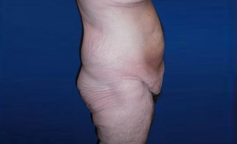 Body Lift Before & After Gallery - Patient 398385 - Image 5