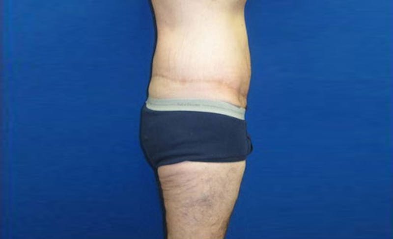 Body Lift Before & After Gallery - Patient 398385 - Image 6