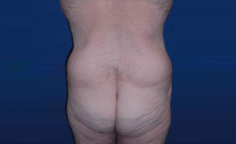 Body Lift Before & After Gallery - Patient 398385 - Image 7