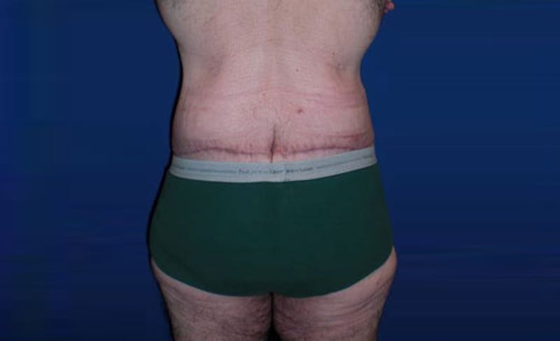 Body Lift Before & After Gallery - Patient 398385 - Image 8