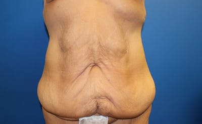 Body Lift Before & After Gallery - Patient 417540 - Image 1
