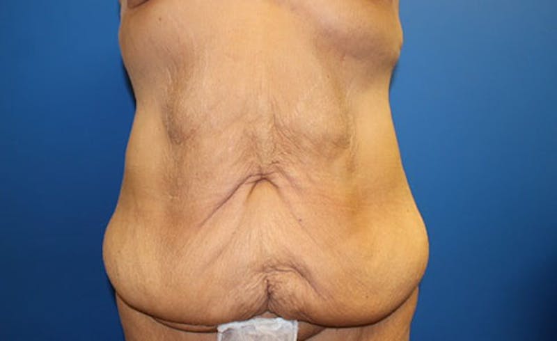Body Lift Before & After Gallery - Patient 417540 - Image 1