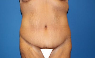 Body Lift Before & After Gallery - Patient 417540 - Image 2