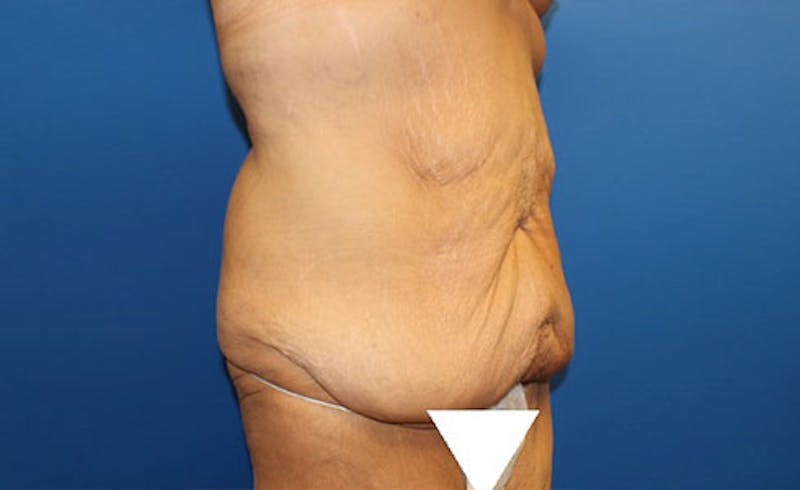 Body Lift Before & After Gallery - Patient 417540 - Image 3