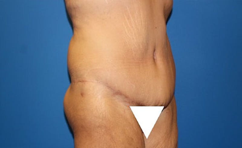 Body Lift Before & After Gallery - Patient 417540 - Image 4