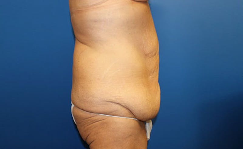 Body Lift Before & After Gallery - Patient 417540 - Image 5